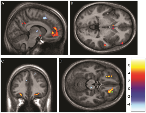 Neural responses associated with viewing pictures of a beloved during periods of acute experimental thermal pain